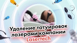 Удаление татуировок лазерами компании Lasertech